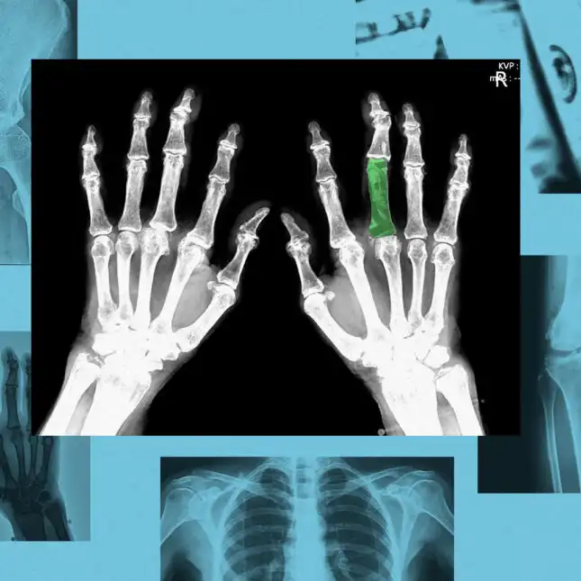 STAT+: Drugmakers, biotech VCs show ‘reinvigorated' interest in osteoporosis treatments